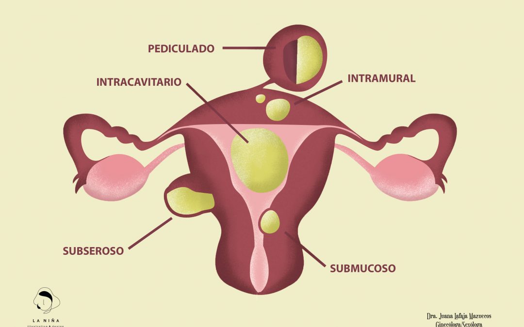 Miomas: ¿sabías que el resveratrol puede ayudar en mujeres con miomas?