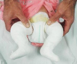 Tratamiento del pie zambo con el método Ponsetí